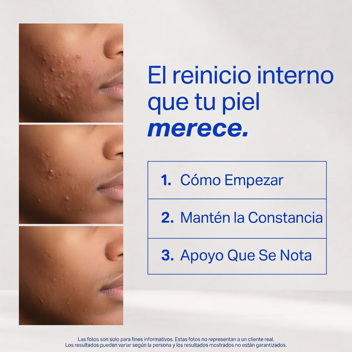 Voryn™ - Suplemento Acné